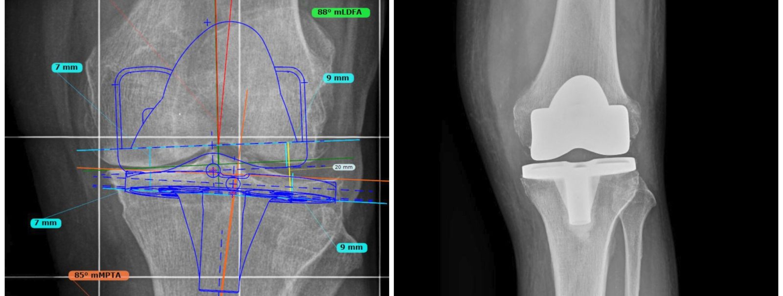 Protesi realizzata con allineamento cinematico