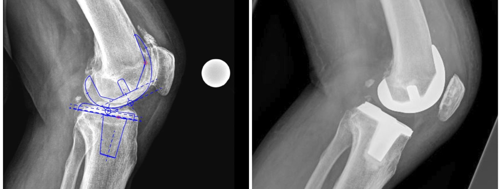 Protesi realizzata con allineamento cinematico